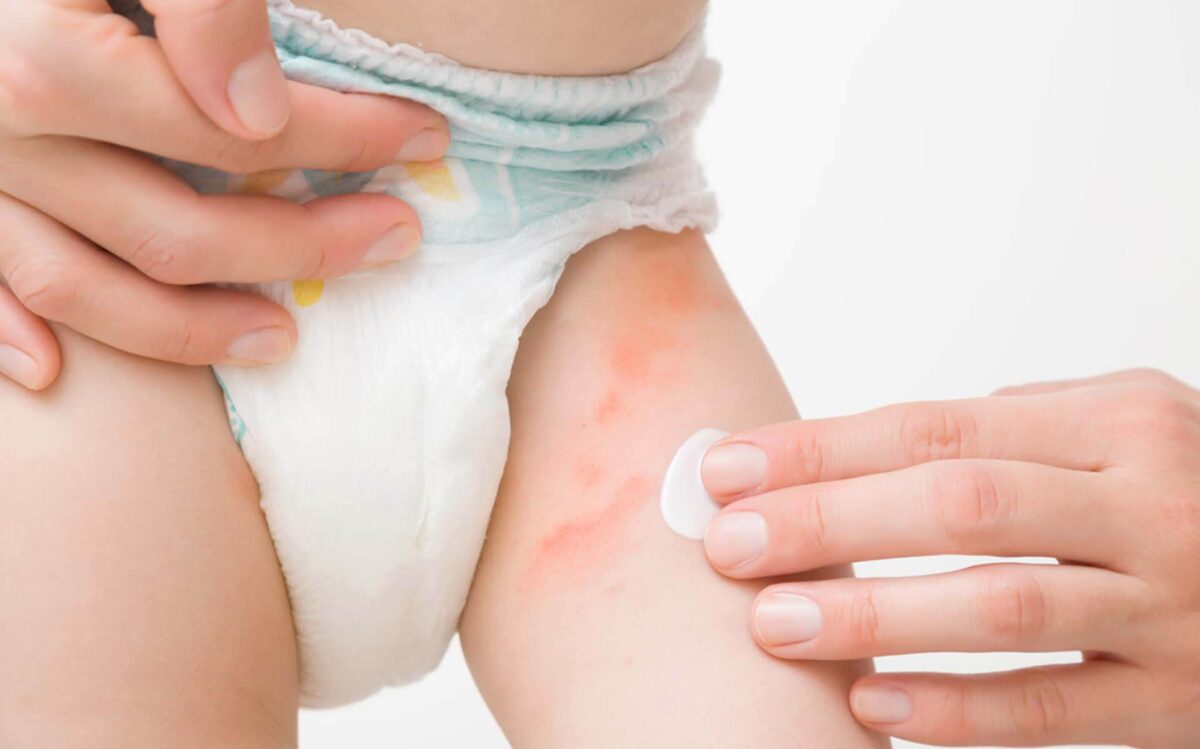 Guia Completo Sobre Alergia Fraldas em Bebês
